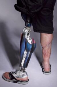 The Alternative Limb Project - Bespoke Prosthetic Limbs