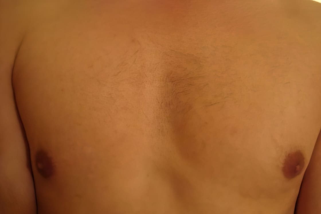 https://www.unfinishedman.com/wp-content/uploads/2021/01/After-Picture-VISS-IPL-2nd-Treatment-Chest-e1317333226206-upscaled.jpg